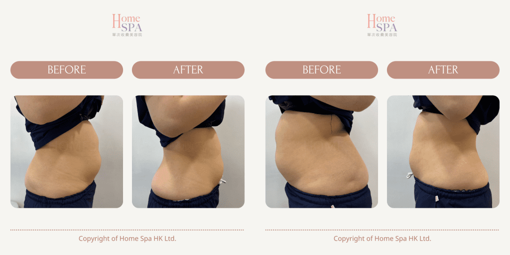 slim treatment result in hongkong -Homespa Mongkok