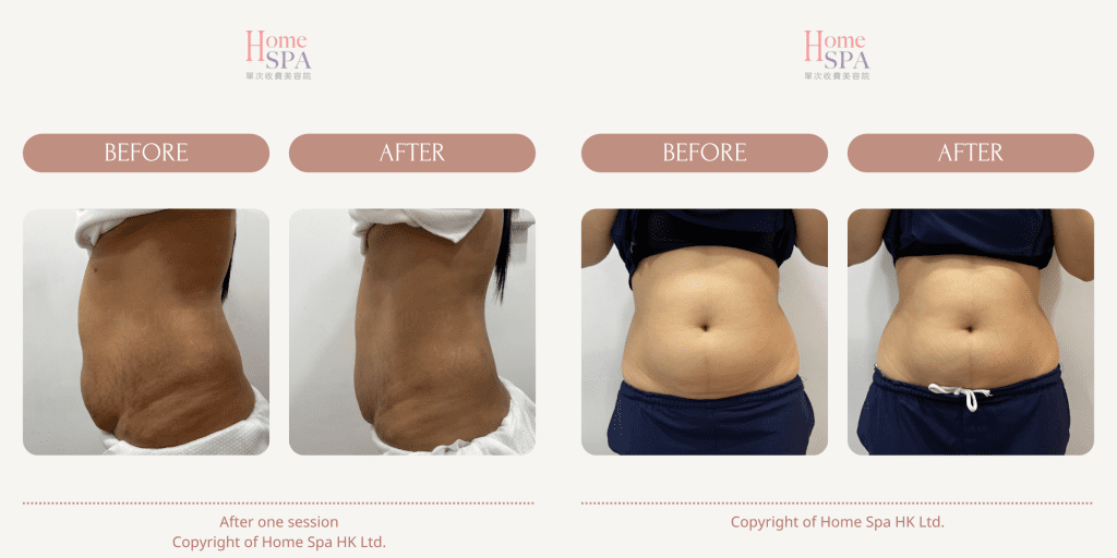 slim treatment result in hongkong -Homespa Mongkok