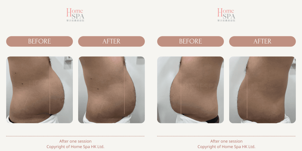 slim treatment result in hongkong -Homespa Mongkok