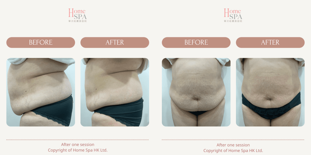 slim treatment result in hongkong -Homespa Mongkok