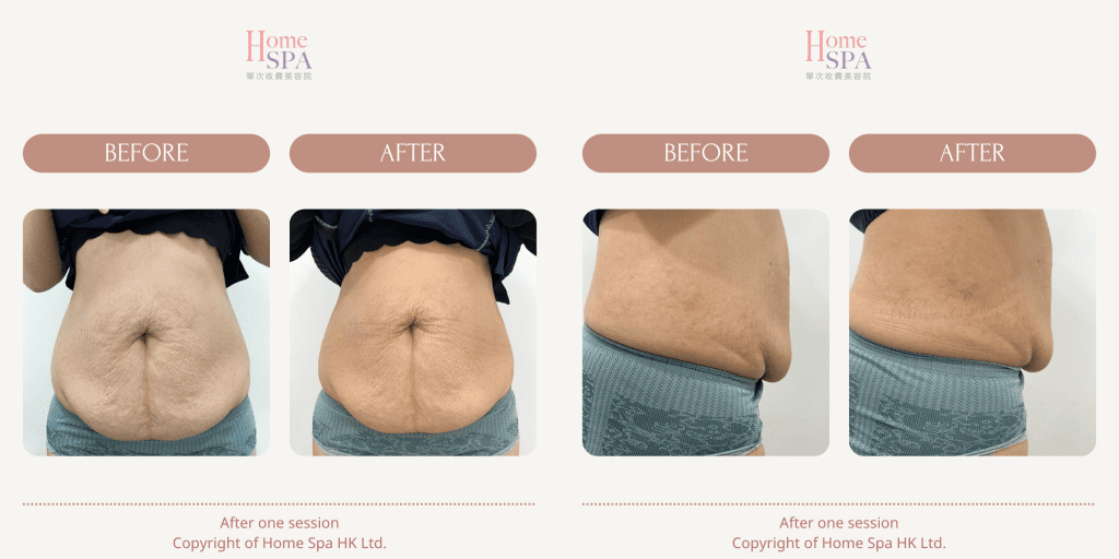 slim treatment result in hongkong -Homespa Mongkok