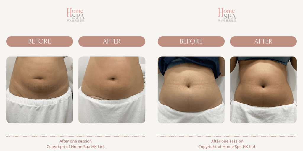 slim treatment result in hongkong -Homespa Mongkok